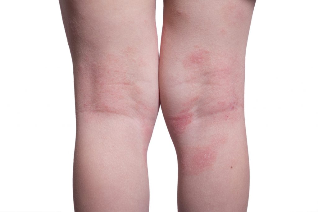 Eczema on the kid’s legs