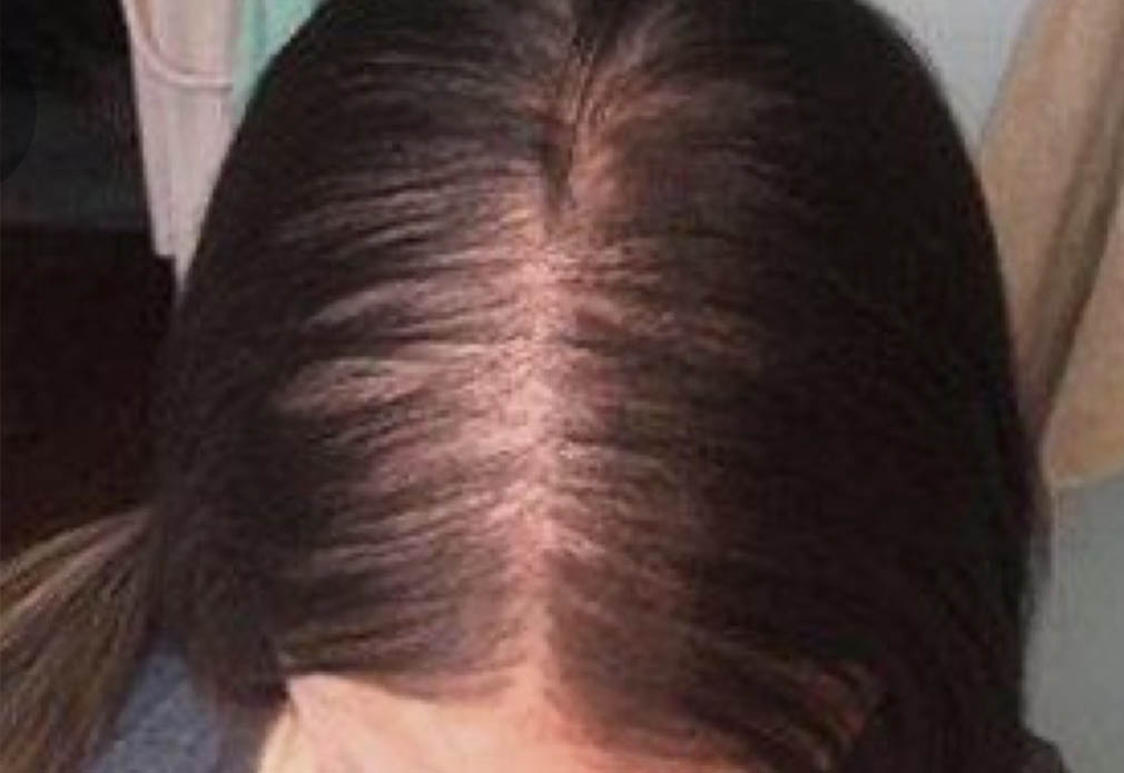 hair-loss-new
